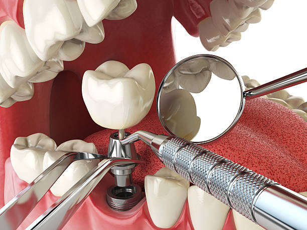 Best Lost Filling or Crown Replacement in Skyline View, PA